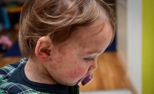 Главная причина распространения вируса – критически низкий уровень вакцинации